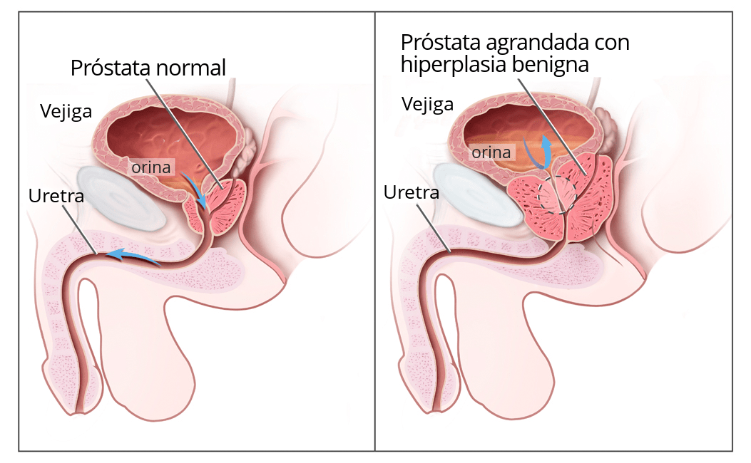 hiperplasia benigna prostática 